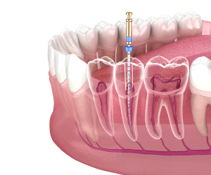 Endodontic Materials